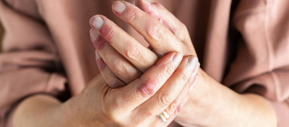 Psoriasis mains-pieds : le tabagisme augmente le risque Psoriasis mains-pieds : le tabagisme augmente le risque